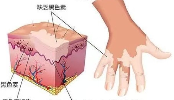郑州治白癜风去哪?京城皮肤刘高岗主任:溯源病因,内调外治攻克白癜风抗复发难题